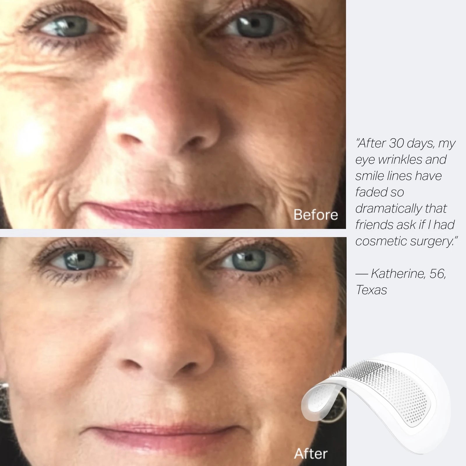 Deepcare+ Targeted Micro-Dart Patches for Smile Lines