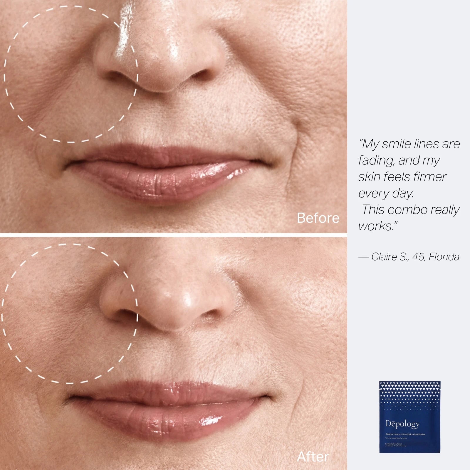 Deepcare+ Targeted Micro-Dart Patches for Smile Lines