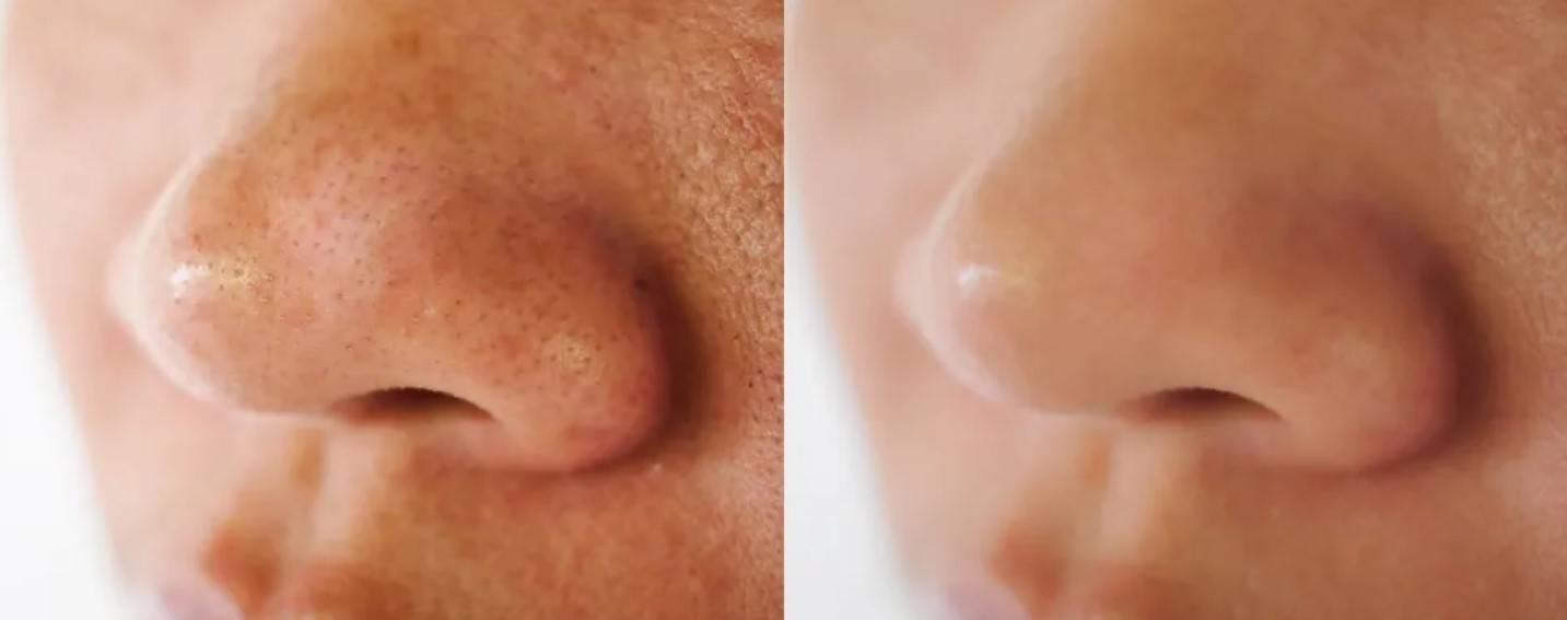How Do Blackheads Form?: Explained