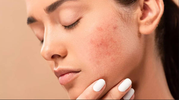 How To Get Rid Of Redness From Acne?