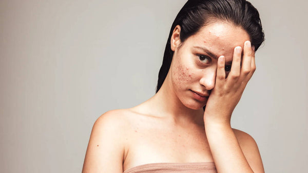 Different Types Of Pimples And Acne : Explained
