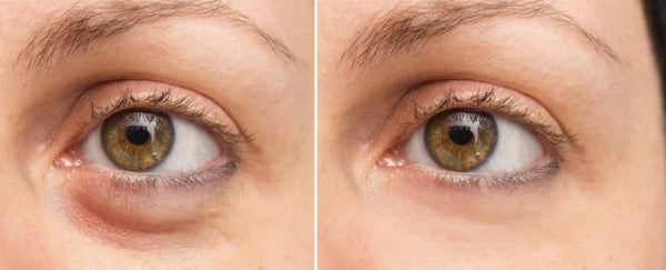 How To Get Rid Of Crepey Skin Under The Eyes? - Tips & Prevention