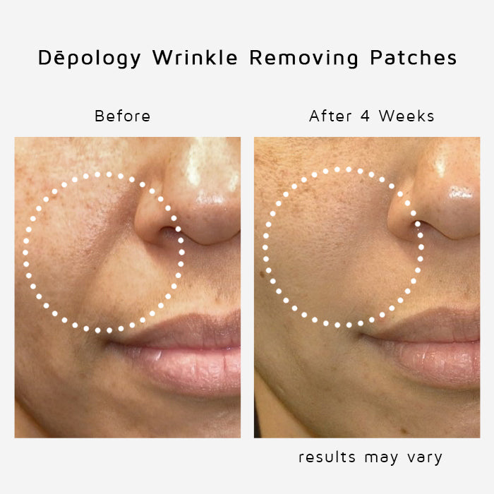Anti-Wrinkle Eye and Smile Microneedle – Patches Depology
